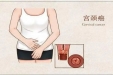 我26岁，未婚，查出了宫颈癌……