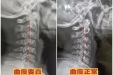 睡觉手麻、偶尔头晕、干呕......颈椎生理曲度变直！怎么办？