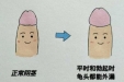 包皮到底要不要割？事关孩子一生，挺急的！在线等……