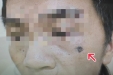 你身上的痣会恶变吗？……长这样的要注意！
