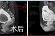 海扶刀治疗子宫肌瘤后，多年不孕的她终于迎来新生宝宝