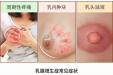 粉红丝带关爱日 | 拯救乳腺增生之歌，今天你听了么？