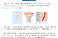 让小小的它发挥大大的作用——曼月乐环固定术