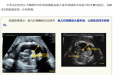 罕见！胎儿胸腔有“积水”，多学科联动施救，护母子平安
