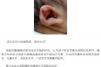 宝宝的耳廓“不漂亮”？柳州妇幼无创耳廓矫治来帮您！