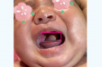 惊奇！新生儿吐奶时嘴里竟含着一个“小肉球”，我院耳鼻咽喉科解难题