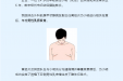 那些你不知道的“男”言之隐——男性乳腺发育症