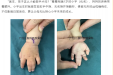 “并”不合适！来看儿童骨科如何巧妙“分手”