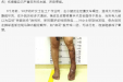 精准矫形，步履重生！我院骨科助创伤性马蹄内翻足患者 “脚踏实地”